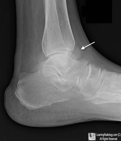 learning-radiology-ankle-joint-effusion